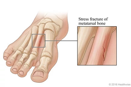 Stress fracture of the foot