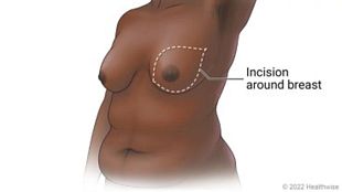 Mastectomy