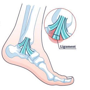 Ankle sprain