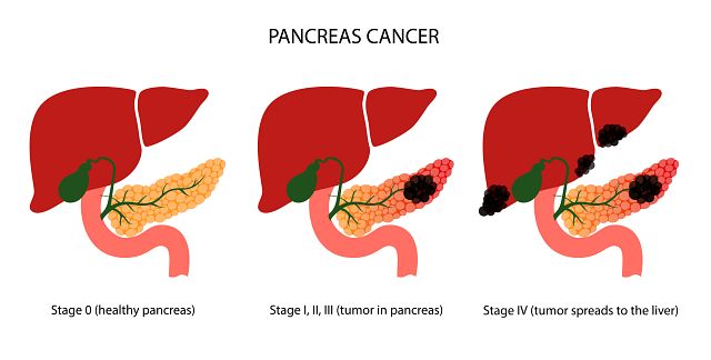 4 stages of pancreatic cancer