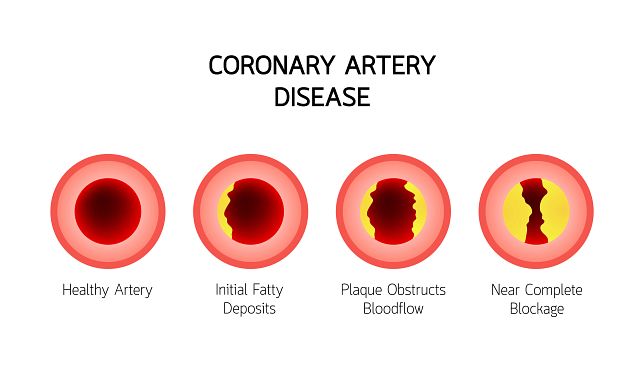 Stages of artery blockage by plaque.