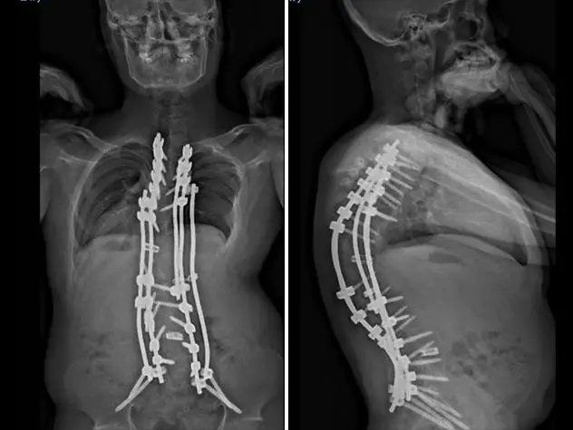 X-rays nine weeks after Chinno’s surgery show his kyphosis and scoliosis significantly improved.