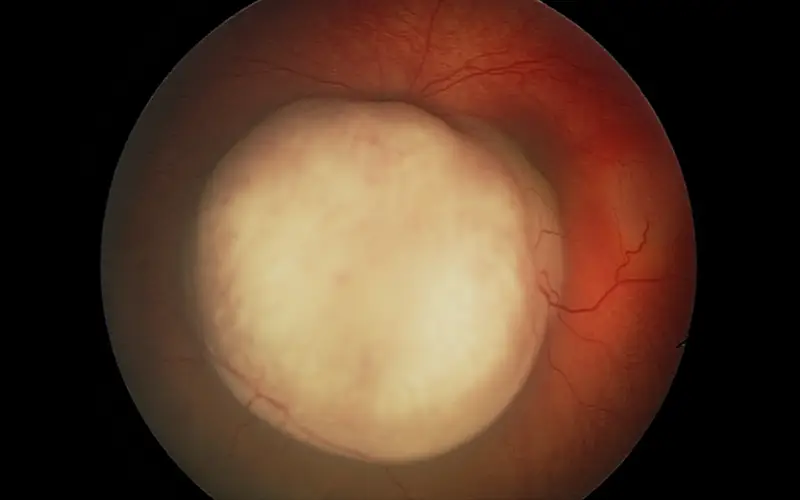Image of retinoblastoma of the left eye