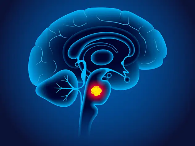 Novel Treatment Delivers Medication to the Brainstem to Treat Aggressive Pediatric Brain Tumor